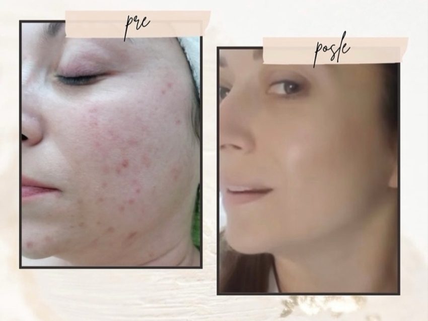 akne ceca skin care nega kože