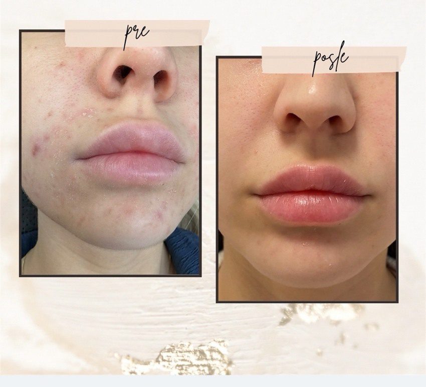 ceca skin care uspešno lečenje problematične kože
