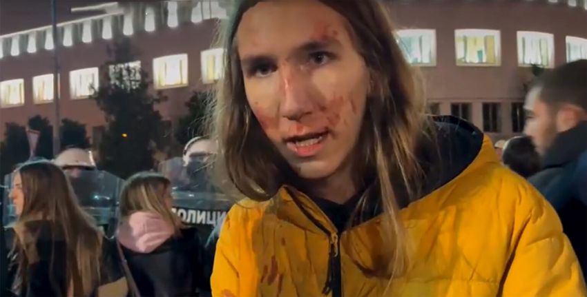 Napadnut student Vukašin Đinović: “Ničim izazvan, štitom u glavu”